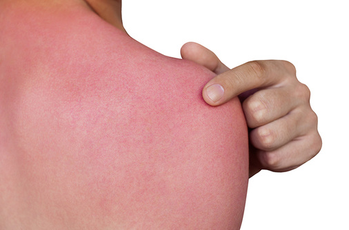 



Sonnencreme kann eine entsprechende Kleidung nicht ersetzen. Mit einem leichten, aber nicht lichtdurchlässigen Baumwollhemd ist schon viel erreicht.
